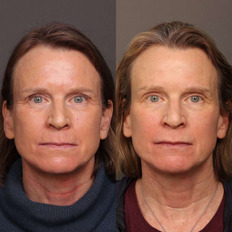 After Image: Botox & Skinvive - front