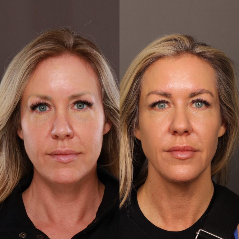 Before Image: Eyebrow Transplant - front
