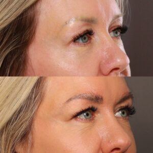 After Image: Eyebrow Transplant