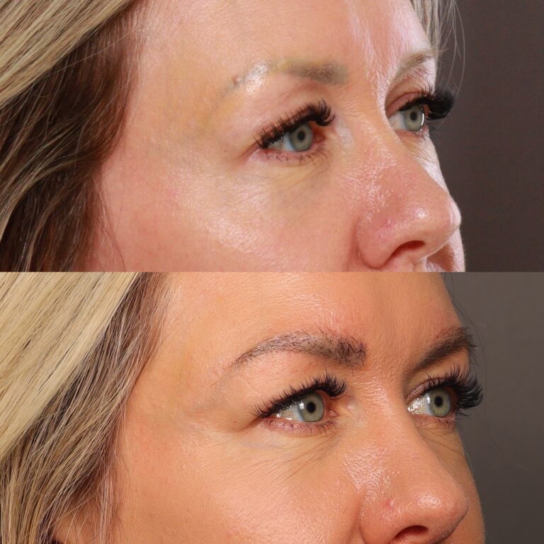 After Image: Eyebrow Transplant - front