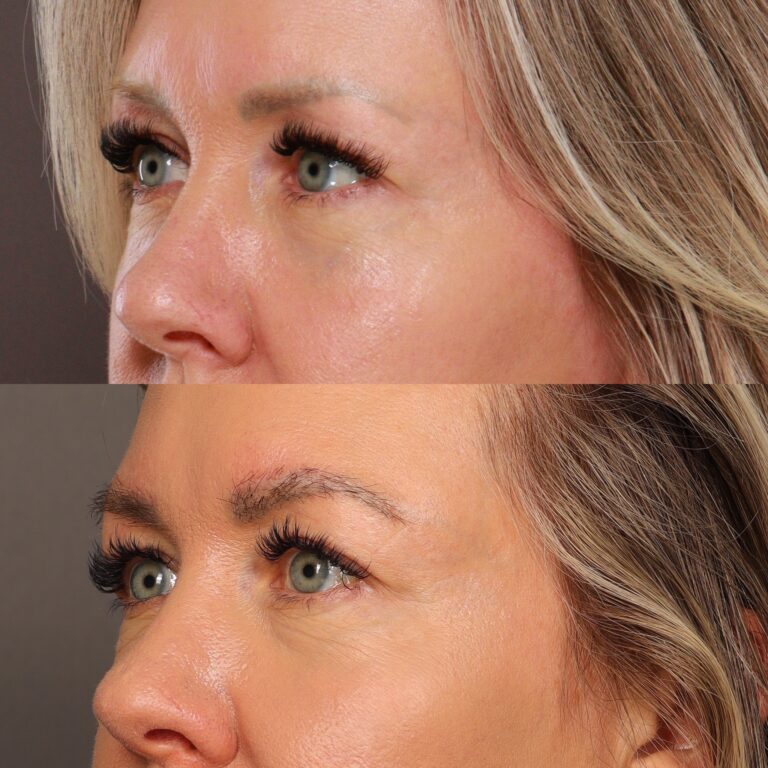 After Image: Eyebrow Transplant - front