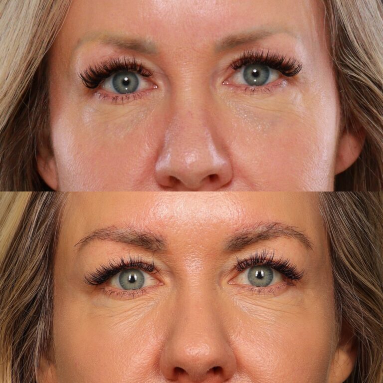 Before Image: Eyebrow Transplant - front