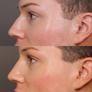 Before Image: Liquid Rhinoplasty