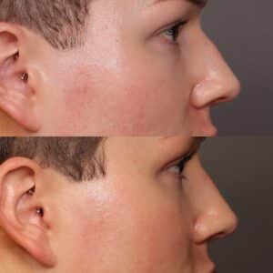 After Image: Liquid Rhinoplasty