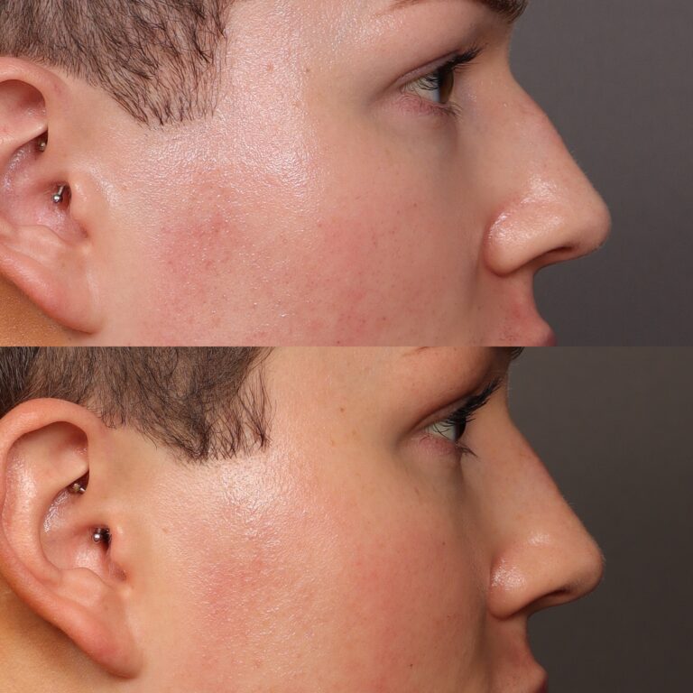 After Image: Liquid Rhinoplasty - front