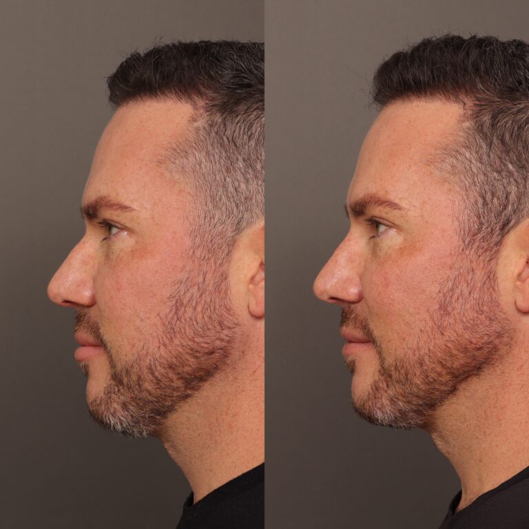 After Image: Nasal Profile Refinment - 
