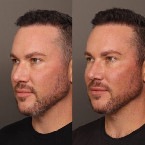 After Image: Nasal Profile Refinment