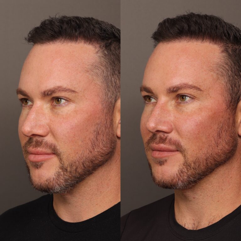 After Image: Nasal Profile Refinment - front