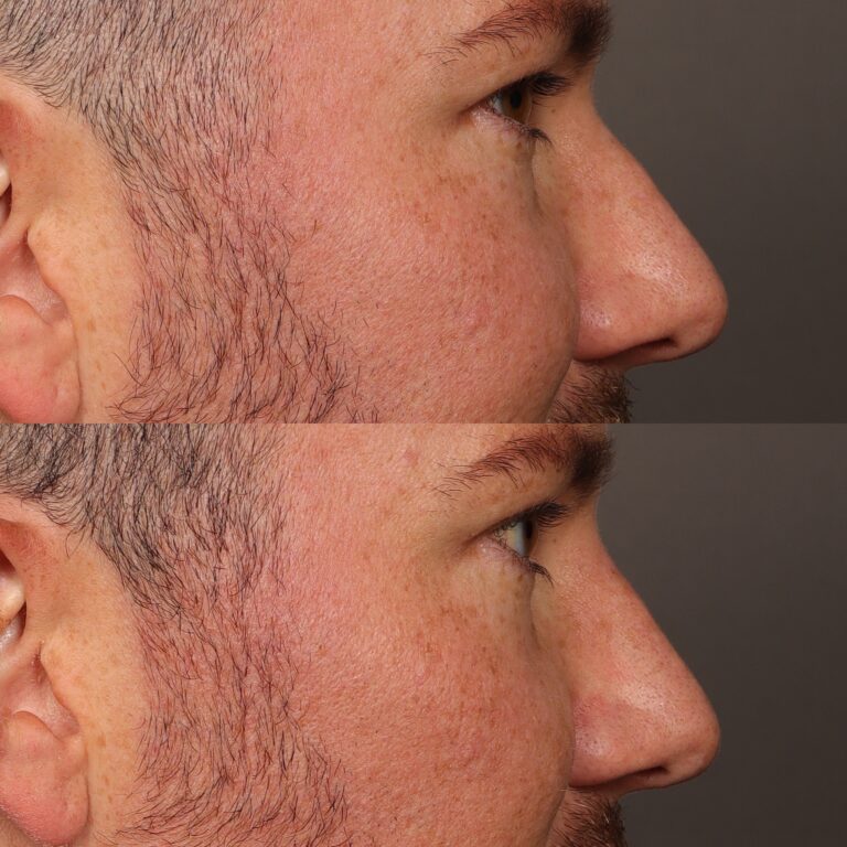 Before Image: Nasal Profile Refinment - 