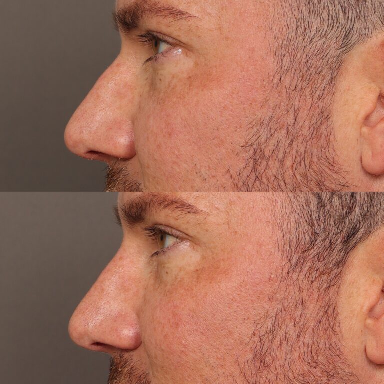Before Image: Nasal Profile Refinment - front