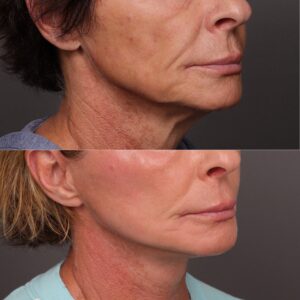 After Image: Facelift, Lower Eyelid Lift & Fat Grafting