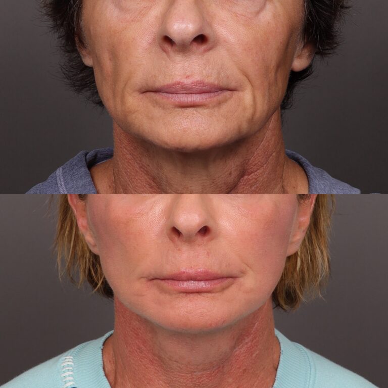 After Image: Facelift, Lower Eyelid Lift & Fat Grafting - front