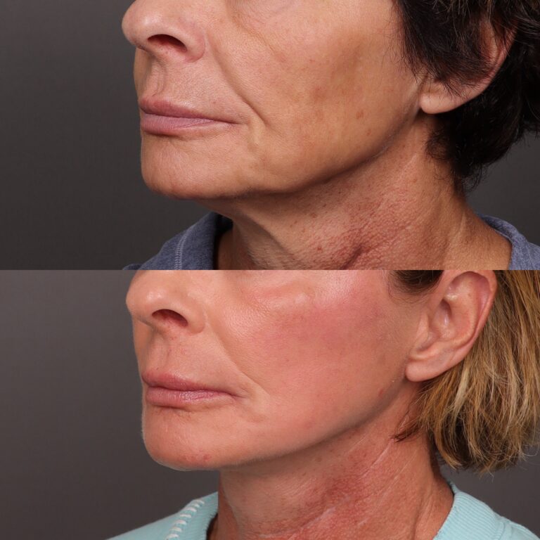 Before Image: Facelift, Lower Eyelid Lift & Fat Grafting - front