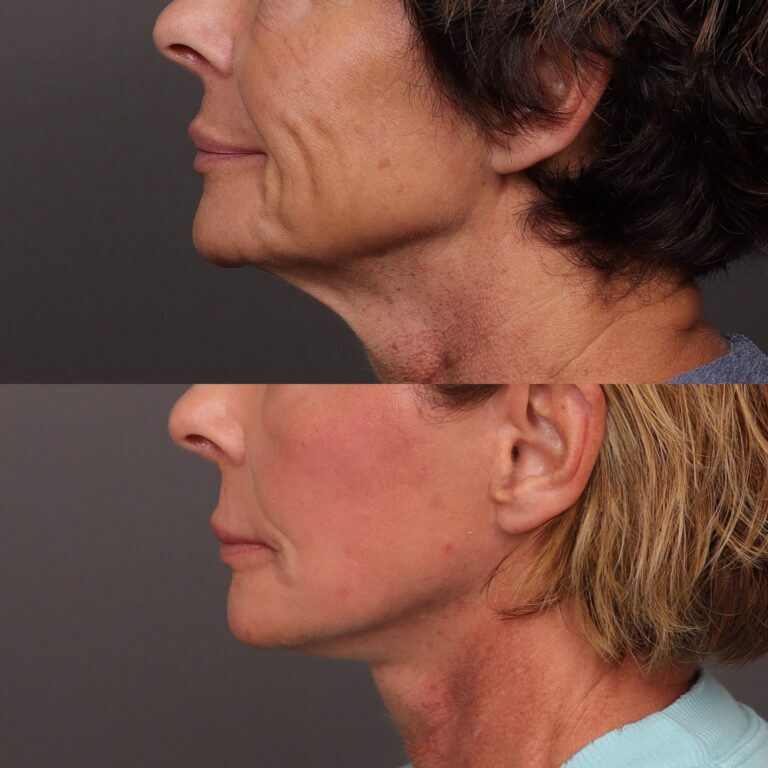 After Image: Facelift, Lower Eyelid Lift & Fat Grafting - front