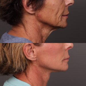 Before Image: Facelift, Lower Eyelid Lift & Fat Grafting