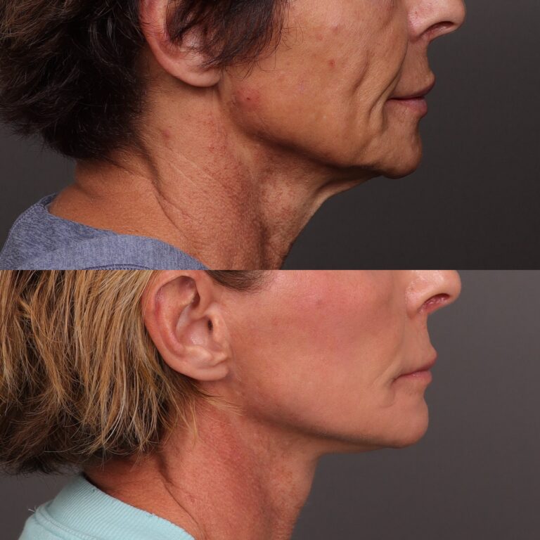 Before Image: Facelift, Lower Eyelid Lift & Fat Grafting - front