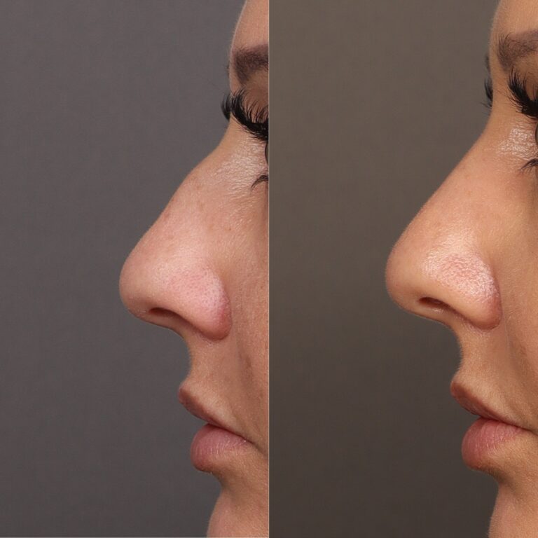 After Image: Bump Shave - front