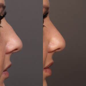 Before Image: Bump Shave