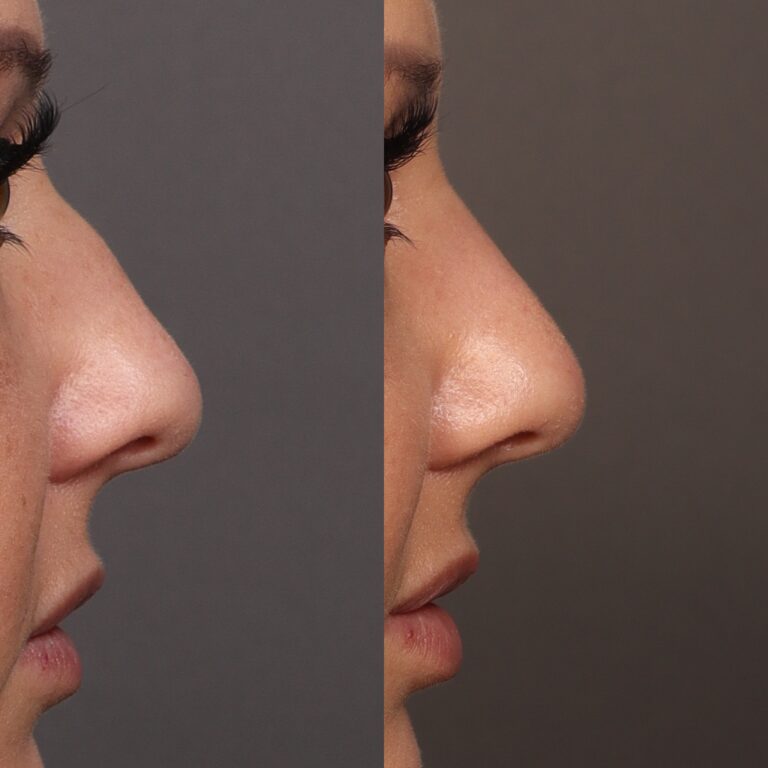 Before Image: Bump Shave - front
