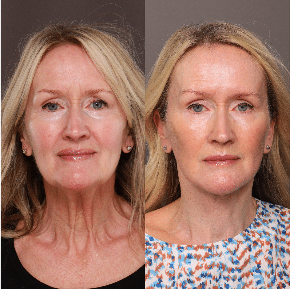Before and after facelift results for a 63-year-old woman, shown 4 months after surgery by Dr. Scott Thompson at Utah Facial Plastics. The after photo also reflects Botox treatment by Jeanna Wilkerson and professional Hydrafacial and DiamondGlow treatments. Noticeable improvements include a firmer jawline, smoother neck, reduced facial sagging, softened wrinkles, and a more refreshed, youthful appearance while maintaining natural facial features.