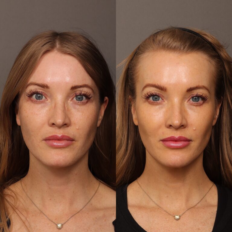 Before Image: Cheek, Chin & Lip Filler - front