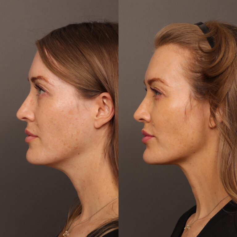 Before Image: Cheek, Chin & Lip Filler - 