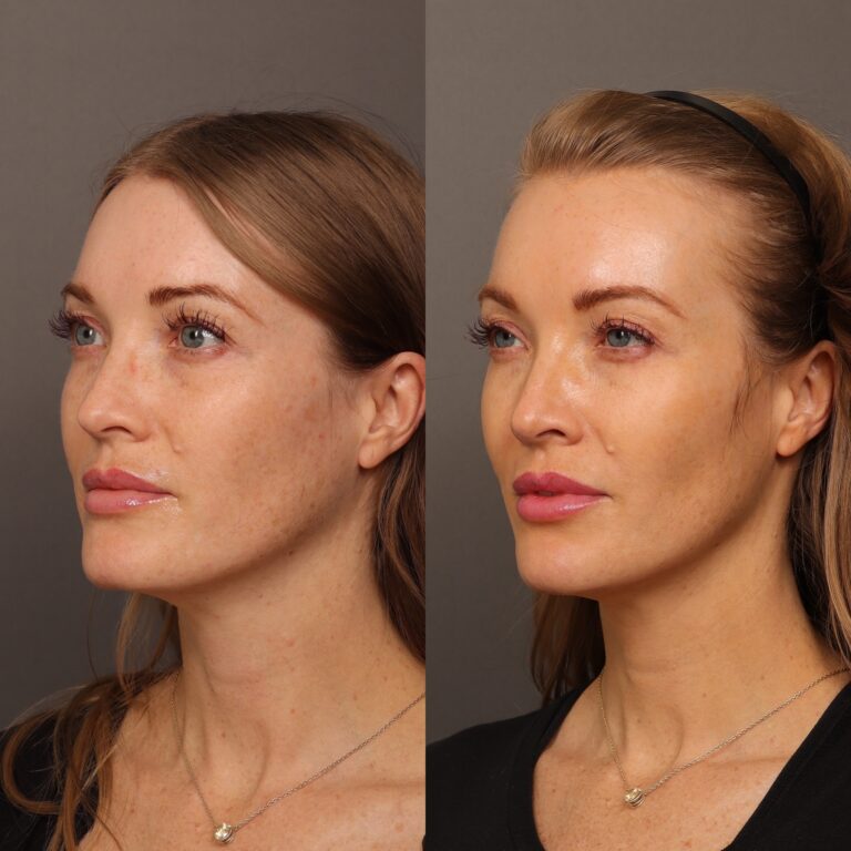 After Image: Cheek, Chin & Lip Filler - front
