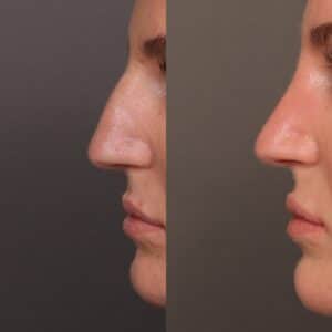 Before Image: Bump Shave