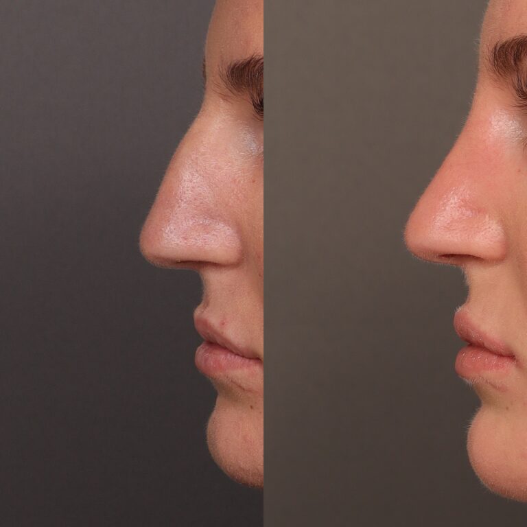 Before Image: Bump Shave - front