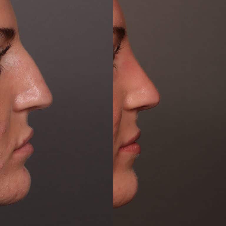 After Image: Bump Shave - front
