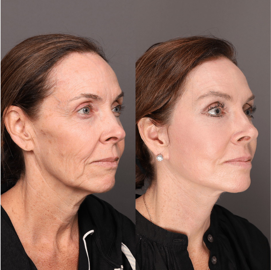Before and after facelift results for a 57-year-old woman, shown 6 months after facelift surgery by Dr. Scott Thompson at Utah Facial Plastics. The after photo also reflects Contour TRL laser skin resurfacing performed by Katy Larson 4 months earlier. Results show a smoother jawline and neck, improved facial contours, reduced skin laxity, softened wrinkles, and brighter, more even skin tone with natural-looking facial rejuvenation.