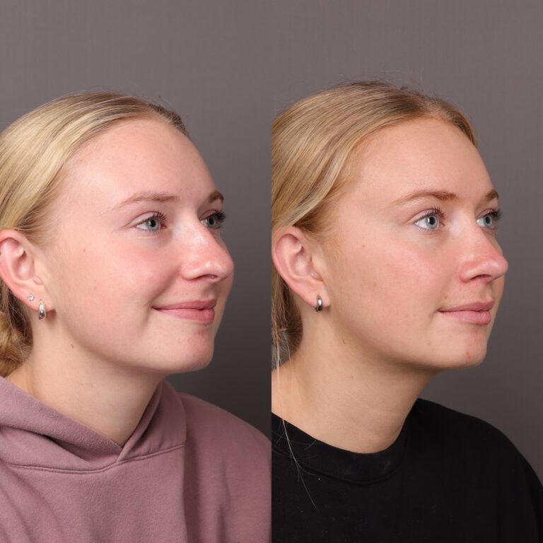 Before Image: Rhinoplasty - front