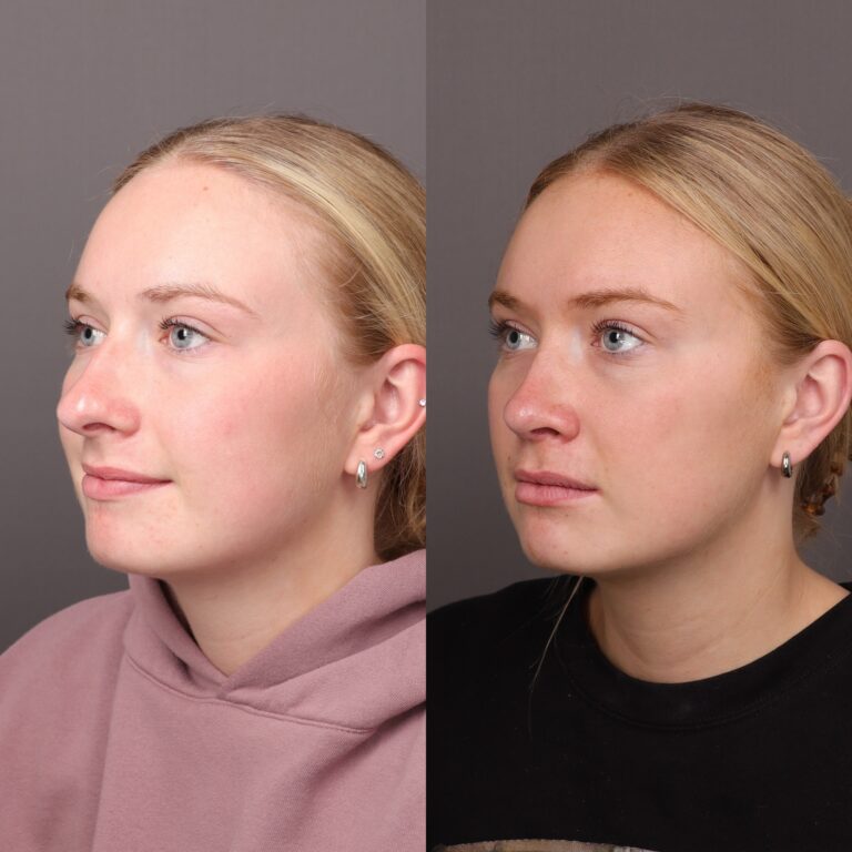 Before Image: Rhinoplasty - front