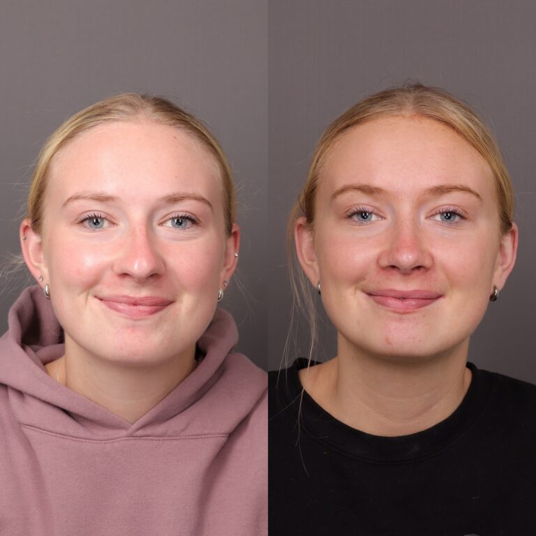 After Image: Rhinoplasty - front