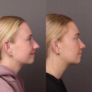 After Image: Rhinoplasty