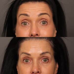 Before Image: Botox