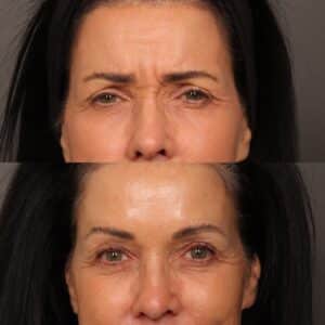 After Image: Botox