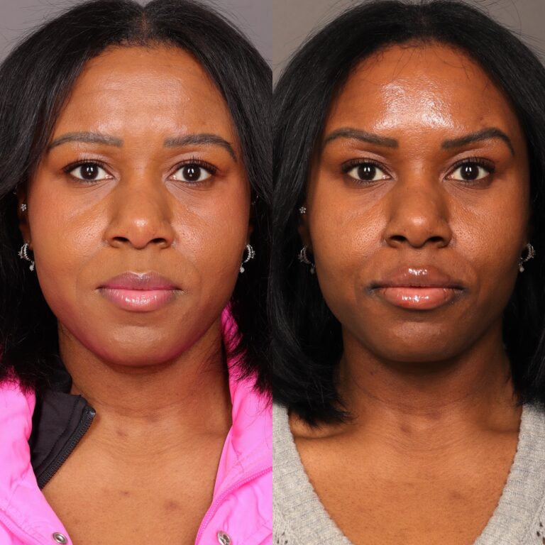 Before Image: Lip Filler & Botox - front