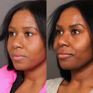 After Image: Lip Filler & Botox