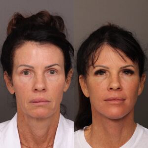 After Image: Facelift, Lower Eyelid Lift & Fat Grafting