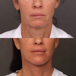 Before Image: Facelift, Lower Eyelid Lift & Fat Grafting