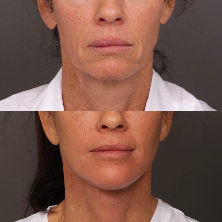 Before Image: Facelift, Lower Eyelid Lift & Fat Grafting - front