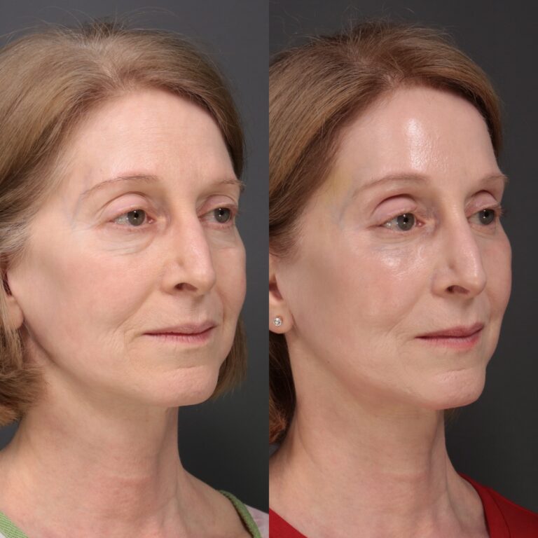 After Image: Laser Skin Resurfacing - front