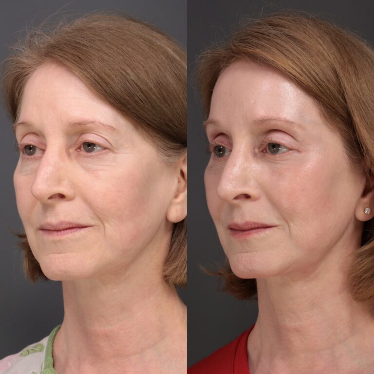After Image: Laser Skin Resurfacing - front