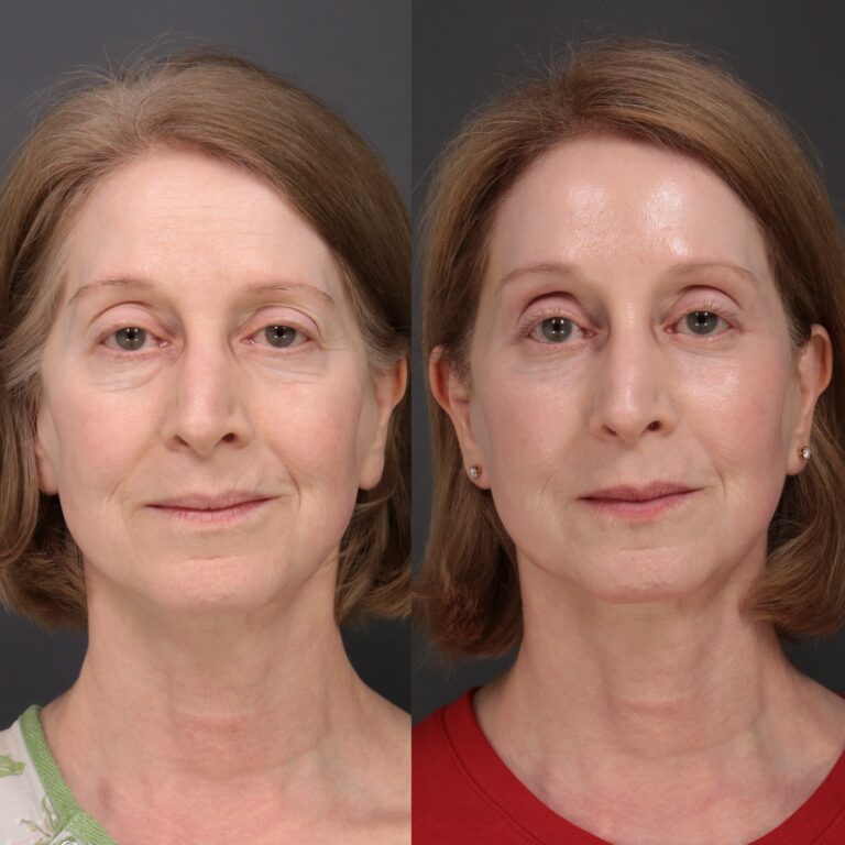 Before Image: Laser Skin Resurfacing - front