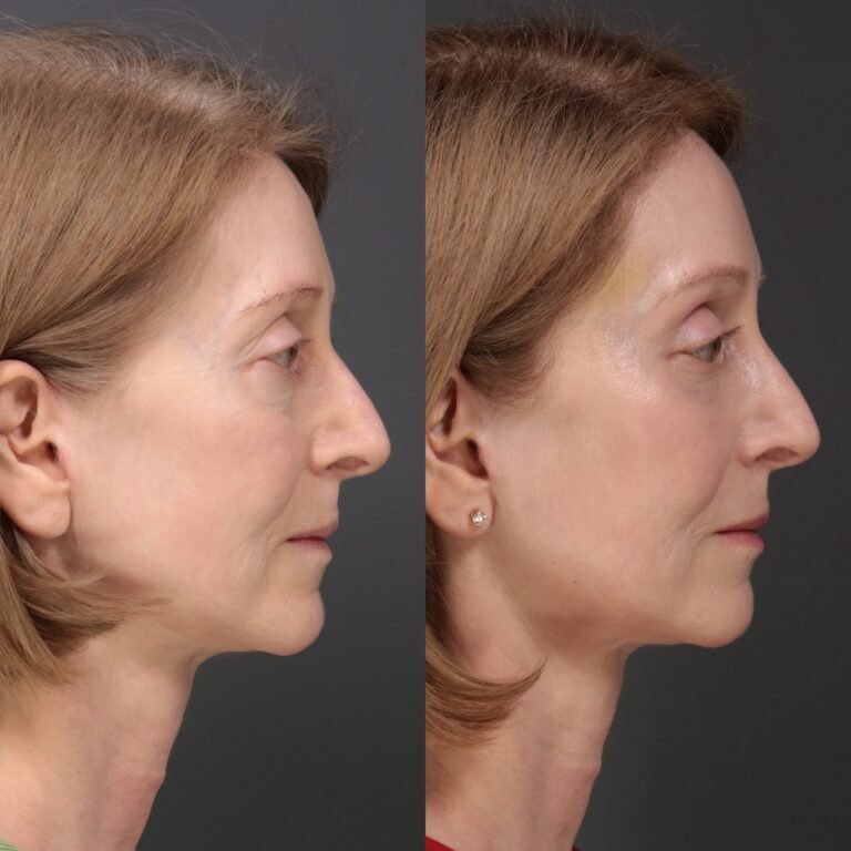 Before Image: Laser Skin Resurfacing - front