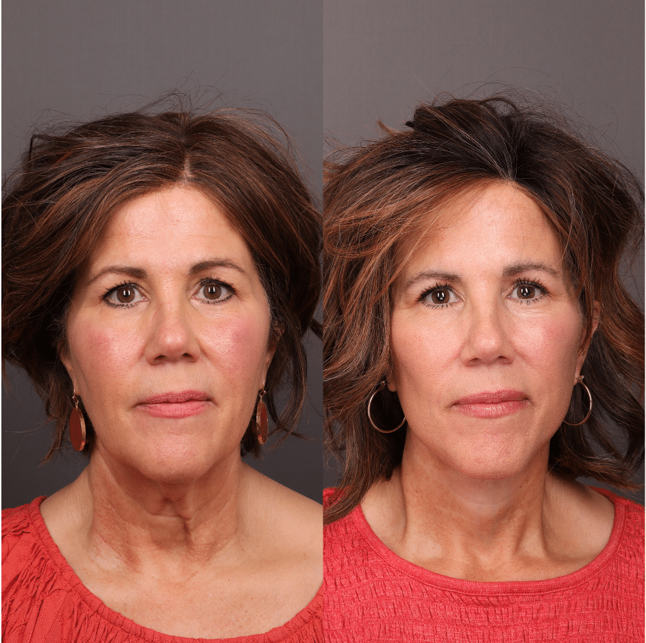 Lifting facial de plano profundo, blefaroplastia superior realizada por el Dr. Thompson. 62 años. 3 meses después de la cirugía. Centro de Cirugía Estética Draper, Utah Facial Plastics. Vista frontal.