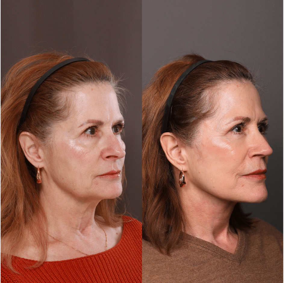 Facelift, Lower, Fat Grafting, Rhinoplasty by Dr. Thompson. Age 65. 11 months post operative.