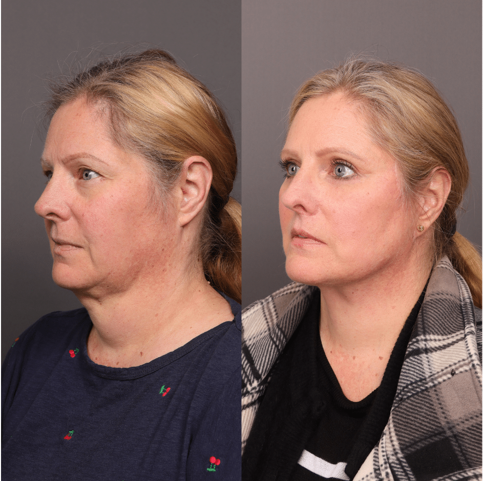Imágenes de antes y después de un lifting facial, blefaroplastia superior e inferior e injerto de grasa realizado por el Dr. Henstrom. Paciente de 65 años. 4 meses después de la cirugía. Centro de Cirugía Estética Draper, Utah Facial Plastics.