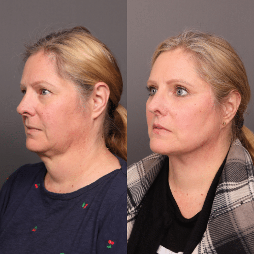 Fotos de antes y después de un lifting facial, blefaroplastia superior e inferior e injerto de grasa realizado por el Dr. Henstrom. Edad: 65 años. 4 meses después de la cirugía. Centro de Cirugía Estética Draper, Utah Facial Plastics. Vista lateral oblicua.